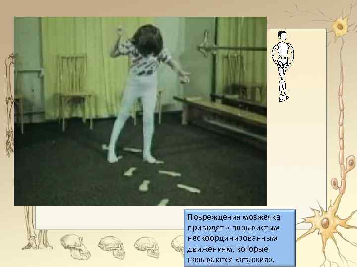 Повреждения мозжечка приводят к порывистым нескоординированным движениям, которые называются «атаксия» . 
