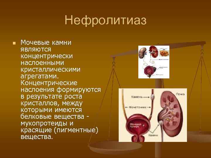 Нефролитиаз n Мочевые камни являются концентрически наслоенными кристаллическими агрегатами. Концентрические наслоения формируются в результате