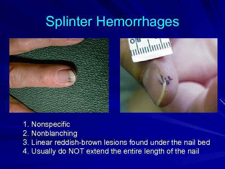 Splinter Hemorrhages 1. Nonspecific 2. Nonblanching 3. Linear reddish-brown lesions found under the nail