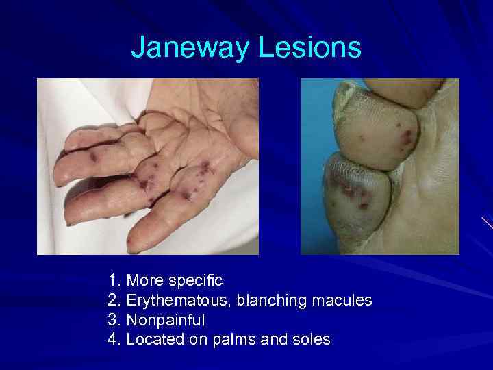 Janeway Lesions 1. More specific 2. Erythematous, blanching macules 3. Nonpainful 4. Located on