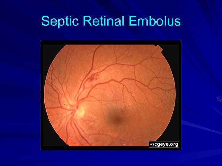 Septic Retinal Embolus 