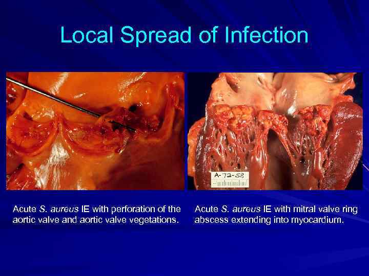 Local Spread of Infection Acute S. aureus IE with perforation of the aortic valve