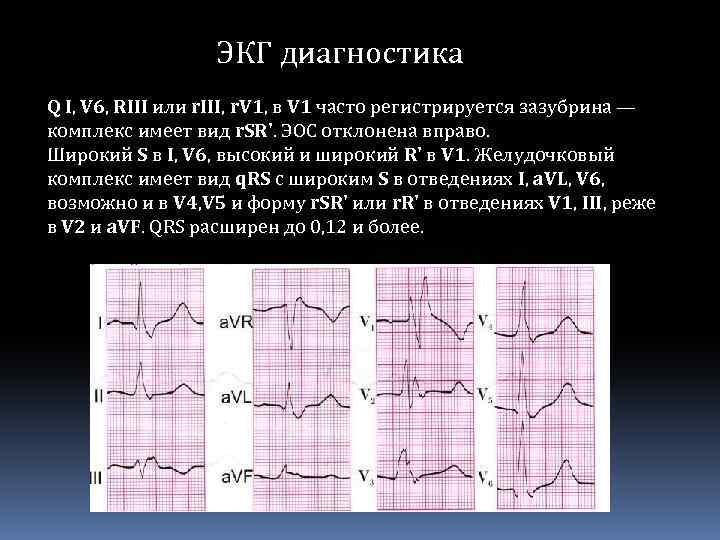 ЭКГ диагностика Q I, V 6, RIII или r. III, r. V 1, в