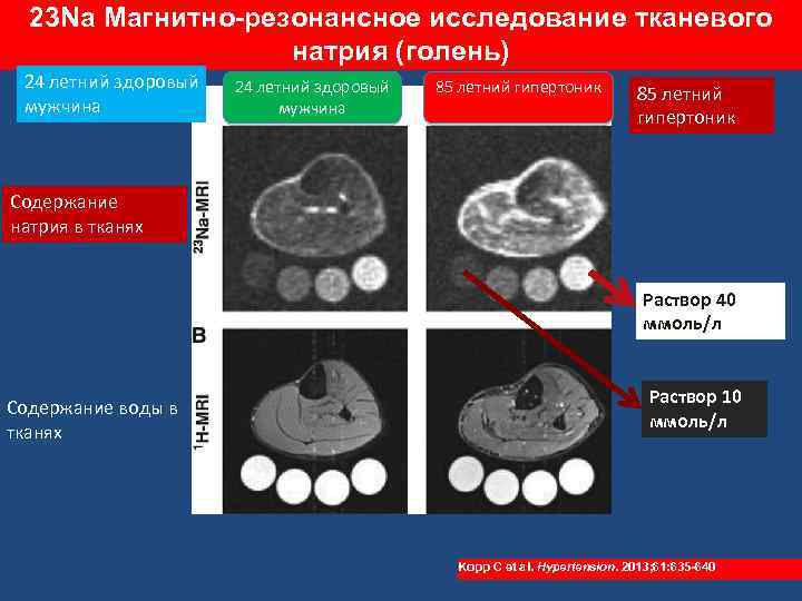 23 Na Магнитно-резонансное исследование тканевого натрия (голень) 24 летний здоровый мужчина 85 летний гипертоник