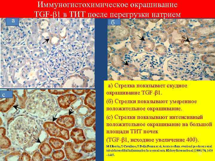 а Иммуногистохимическое окрашивание TGF-β 1 в ТИТ после перегрузки натрием б с с (а)