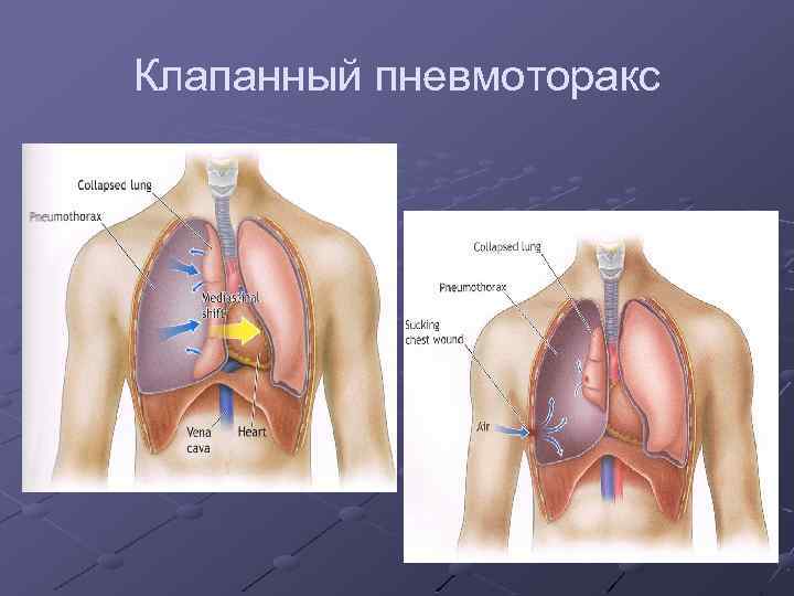 Клапанный пневмоторакс 