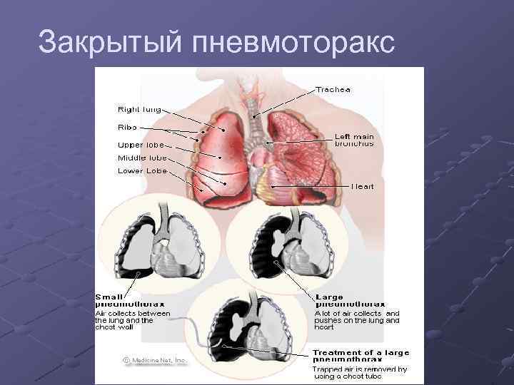 Закрытый пневмоторакс 