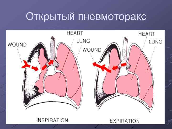 Открытый пневмоторакс 