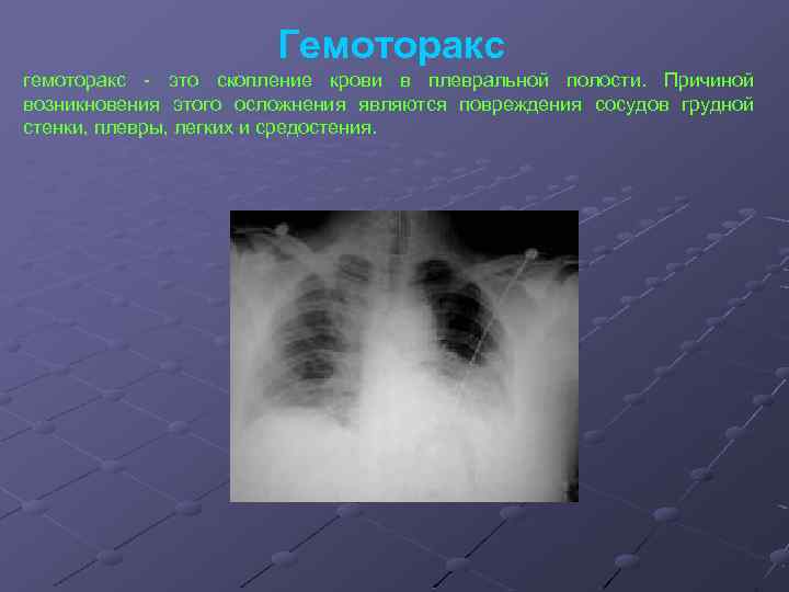 Гемоторакс гемоторакс - это скопление крови в плевральной полости. Причиной возникновения этого осложнения являются