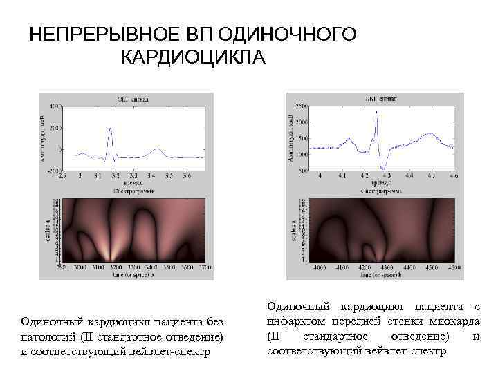 НЕПРЕРЫВНОЕ ВП ОДИНОЧНОГО КАРДИОЦИКЛА Одиночный кардиоцикл пациента без патологий (II стандартное отведение) и соответствующий