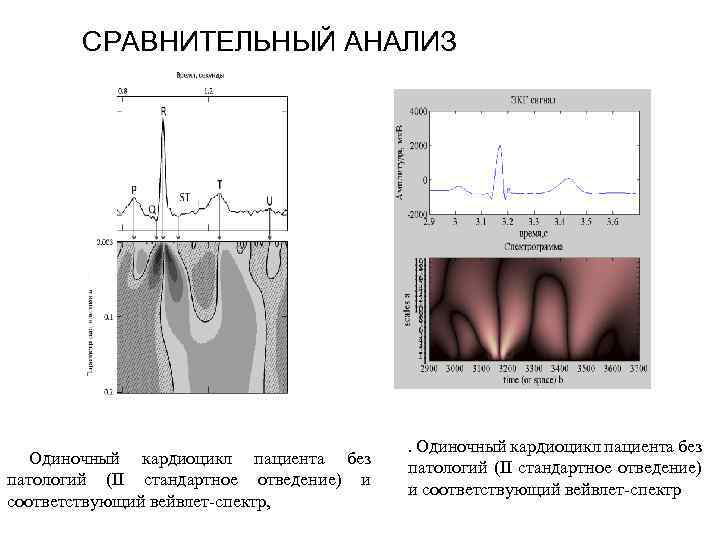 СРАВНИТЕЛЬНЫЙ АНАЛИЗ Одиночный кардиоцикл пациента без патологий (II стандартное отведение) и соответствующий вейвлет-спектр, .