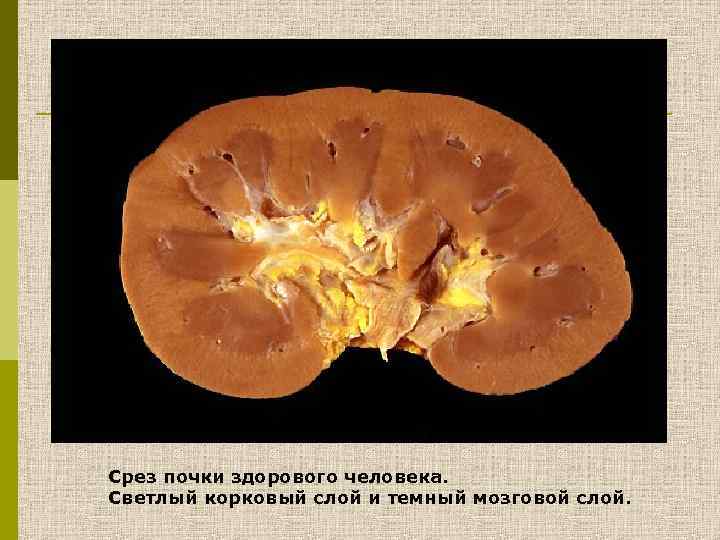 Срез почки здорового человека. Светлый корковый слой и темный мозговой слой. 