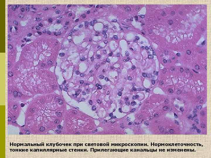 Нормальный клубочек при световой микроскопии. Нормоклеточность, тонкие капиллярные стенки. Прилегающие канальцы не изменены. 