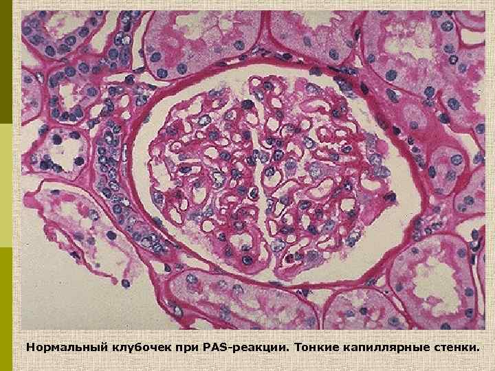 Нормальный клубочек при PAS-реакции. Тонкие капиллярные стенки. 