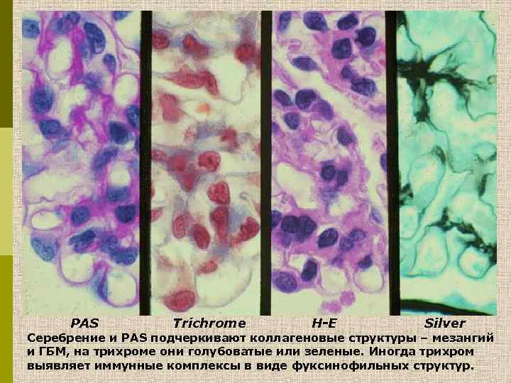 PAS Trichrome H-E Silver Cеребрение и PAS подчеркивают коллагеновые структуры – мезангий и ГБМ,