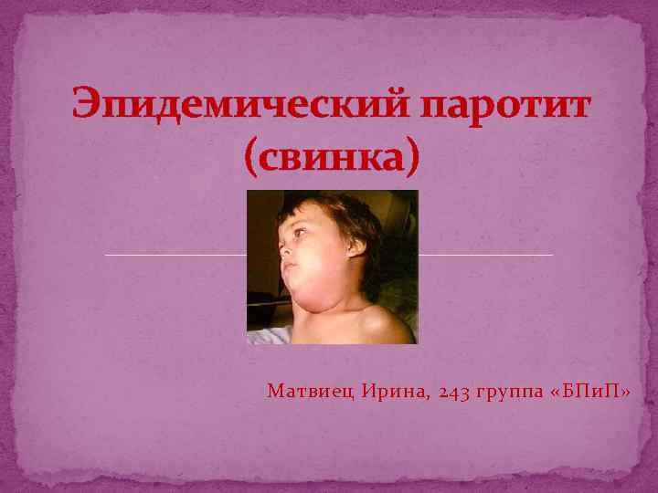 Эпидемический паротит (свинка) Матвиец Ирина, 243 группа «БПи. П» 