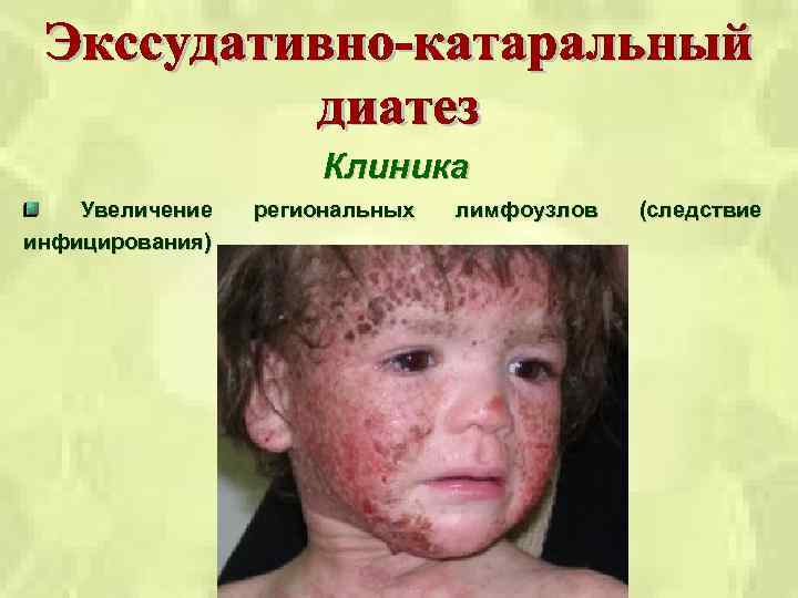 Клиника Увеличение инфицирования) региональных лимфоузлов (следствие 