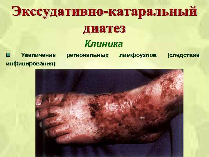 Клиника Увеличение инфицирования) региональных лимфоузлов (следствие 