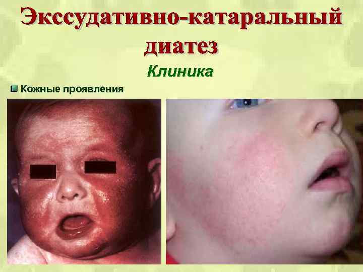 Клиника Кожные проявления 