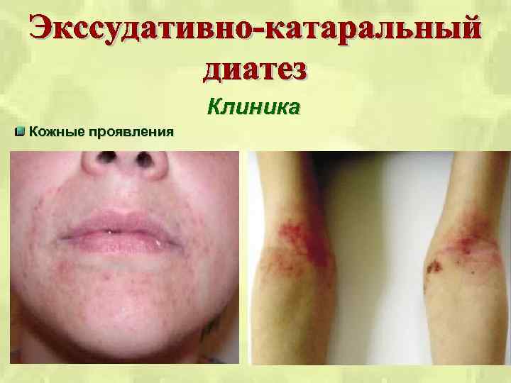 Клиника Кожные проявления 