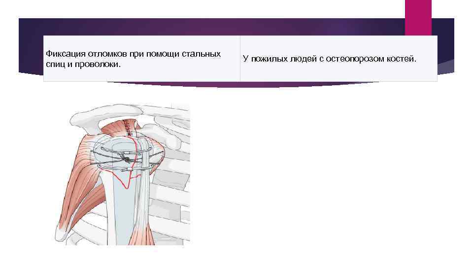 История болезни травматология перелом