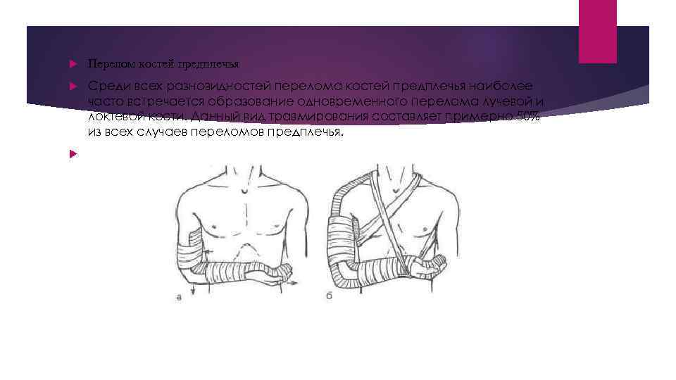  Перелом костей предплечья Среди всех разновидностей перелома костей предплечья наиболее часто встречается образование