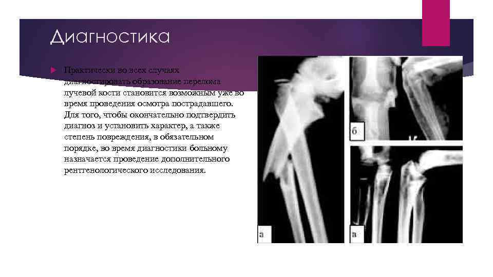 Диагностика Практически во всех случаях диагностировать образование перелома лучевой кости становится возможным уже во