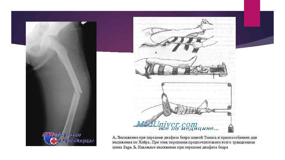 А. Вытяжение при переломе диафиза бедра шиной Томаса и приспособление для вытяжения по Хейра.
