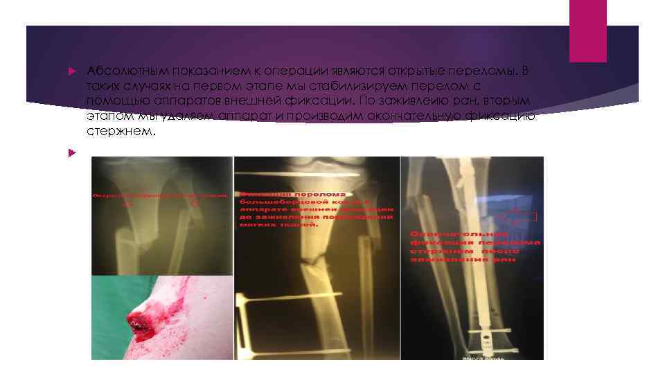  Абсолютным показанием к операции являются открытые переломы. В таких случаях на первом этапе