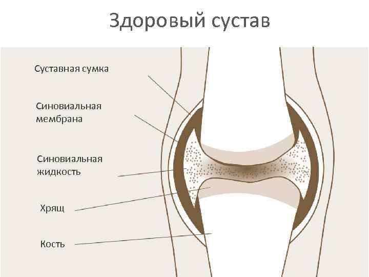 Здоровый сустав Суставная сумка Синовиальная мембрана Синовиальная жидкость Хрящ Кость 