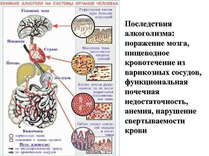 Последствия алкоголизма: поражение мозга, пищеводное кровотечение из варикозных сосудов, функциональная почечная недостаточность, анемия, нарушение