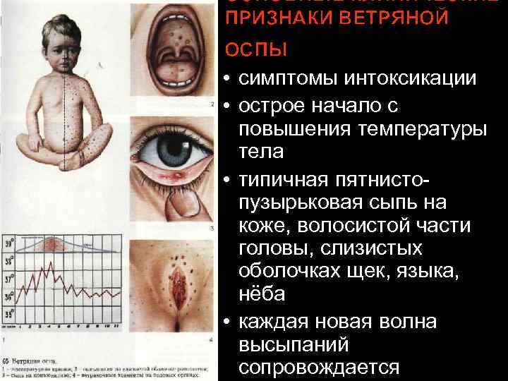 ОСНОВНЫЕ КЛИНИЧЕСКИЕ ПРИЗНАКИ ВЕТРЯНОЙ ОСПЫ • симптомы интоксикации • острое начало с повышения температуры