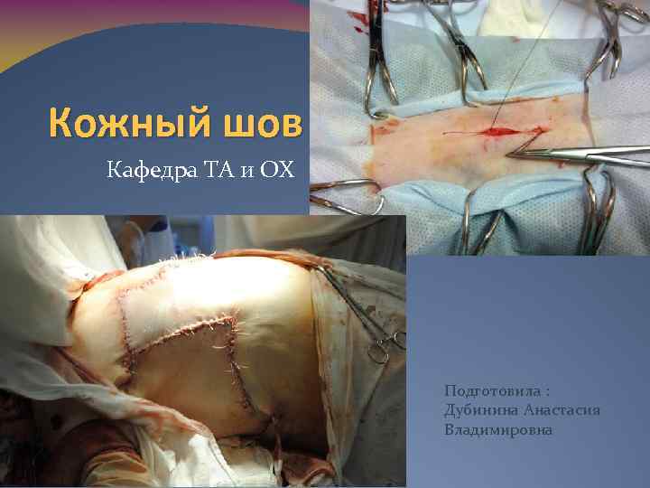 Кожный шов Кафедра ТА и ОХ Подготовила : Дубинина Анастасия Владимировна 