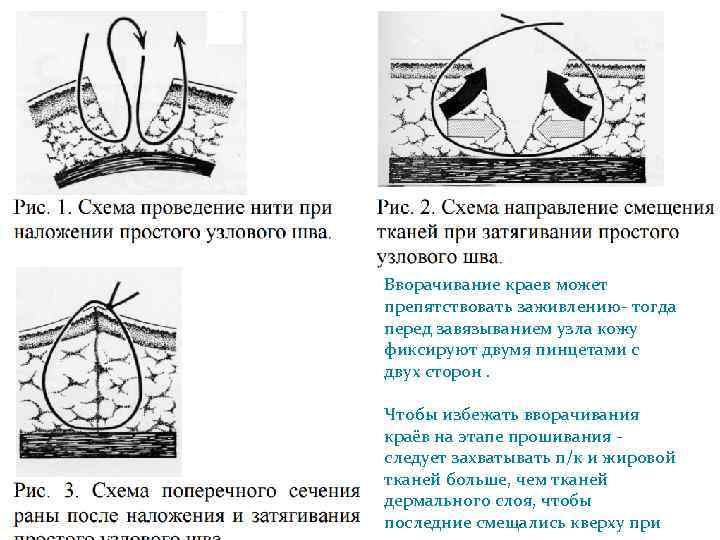 Вворачивание краев может препятствовать заживлению- тогда перед завязыванием узла кожу фиксируют двумя пинцетами с