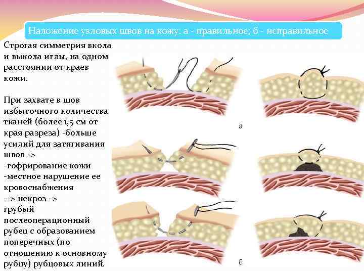 Наложение узловых швов на кожу: а - правильное; б - неправильное Строгая симметрия вкола