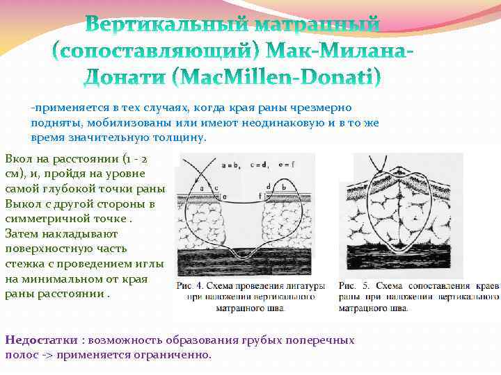 -применяется в тех случаях, когда края раны чрезмерно подняты, мобилизованы или имеют неодинаковую и