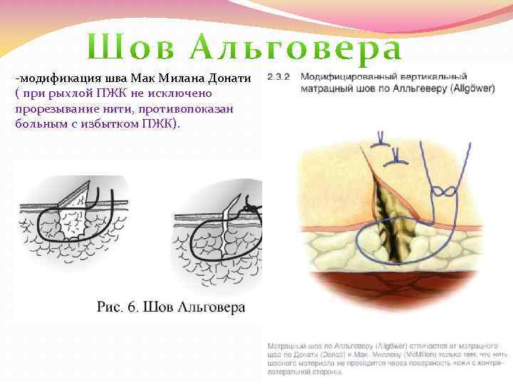 -модификация шва Мак Милана Донати ( при рыхлой ПЖК не исключено прорезывание нити, противопоказан