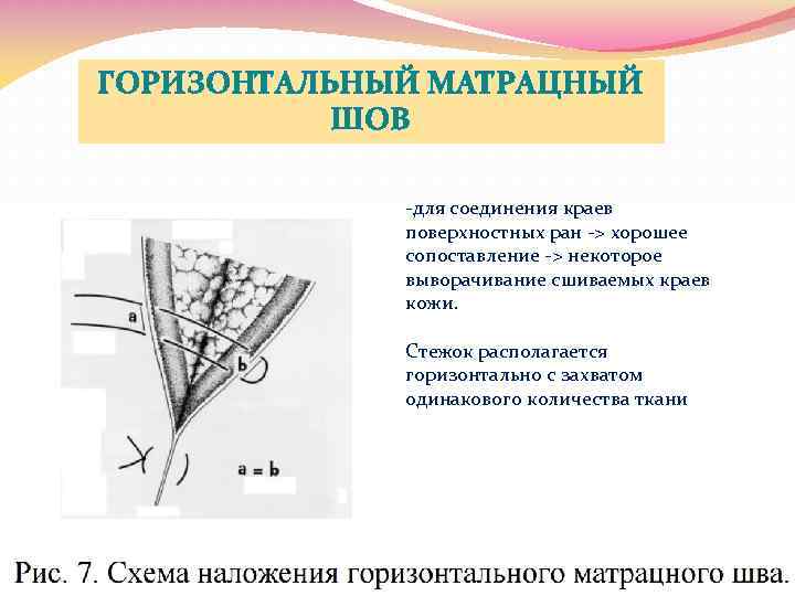 ГОРИЗОНТАЛЬНЫЙ МАТРАЦНЫЙ ШОВ -для соединения краев поверхностных ран -> хорошее сопоставление -> некоторое выворачивание