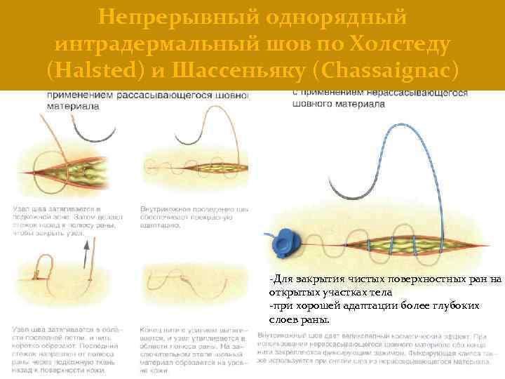 Непрерывный однорядный интрадермальный шов по Холстеду (Halsted) и Шассеньяку (Chassaignac) -Для закрытия чистых поверхностных