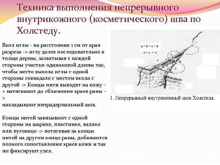 Техника выполнения непрерывного внутрикожного (косметического) шва по Холстеду. Вкол иглы - на расстоянии 1