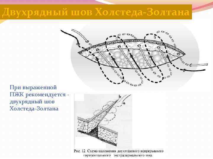 Двухрядный шов Холстеда-Золтана При выраженной ПЖК рекомендуется двухрядный шов Холстеда-Золтана 