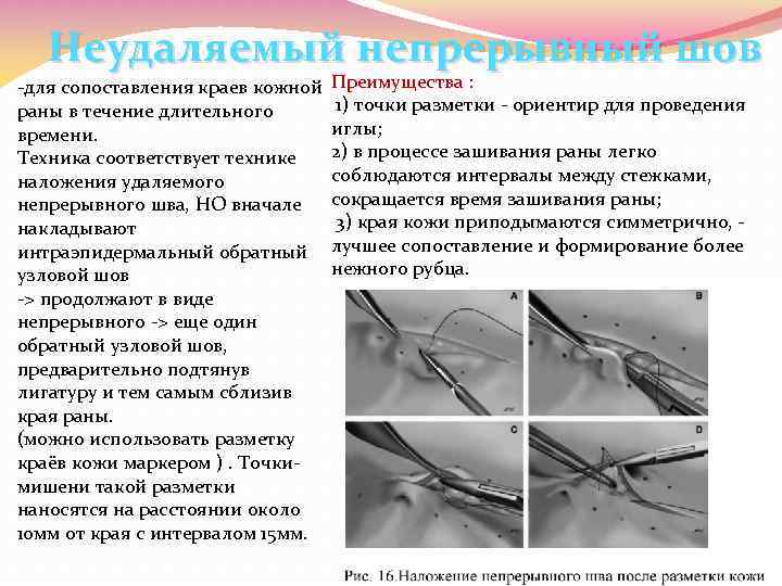 Неудаляемый непрерывный шов -для сопоставления краев кожной раны в течение длительного времени. Техника соответствует