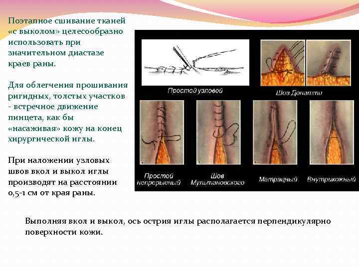 Поэтапное сшивание тканей «с выколом» целесообразно использовать при значительном диастазе краев раны. Для облегчения