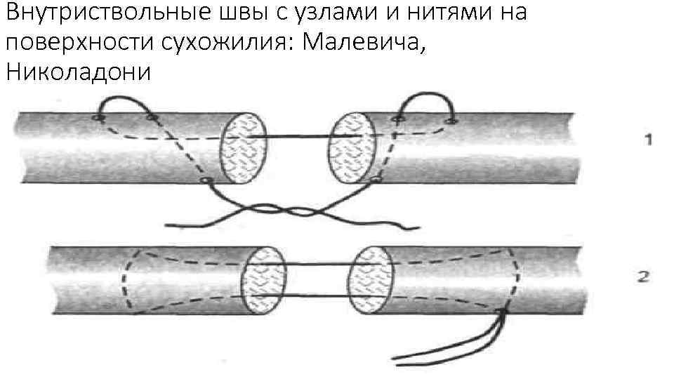 Фото рассасывающихся швов