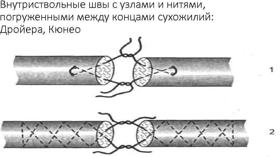 Виды швов хирургия фото