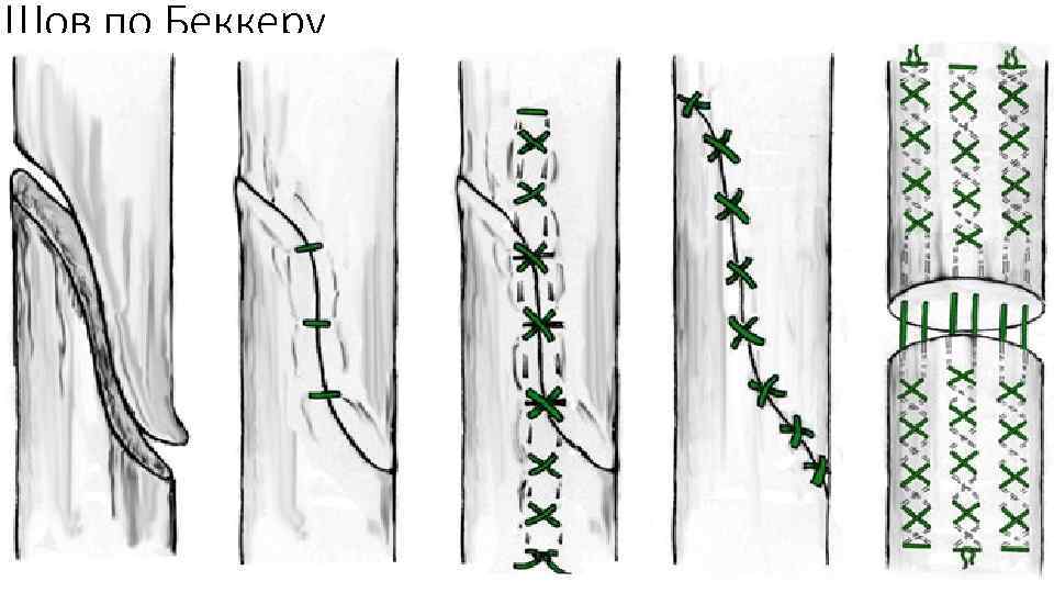Шов по Беккеру 