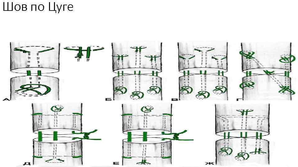 Шов по Цуге 