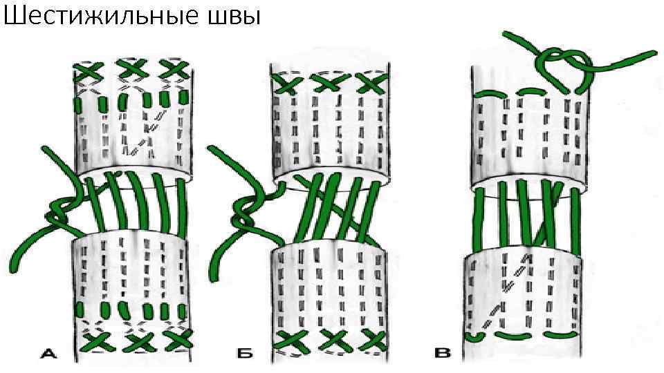 Шестижильные швы 