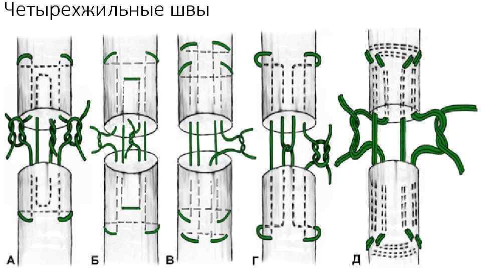Четырехжильные швы 