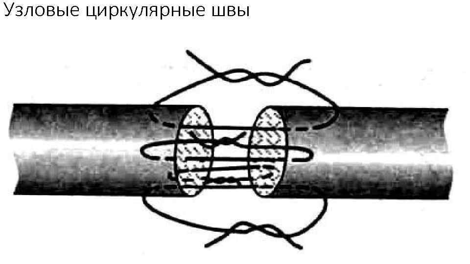 Узловые циркулярные швы 